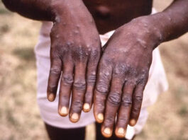 Les premiers symptômes de l'infection à Mpox (variole du singe) sont la fièvre, des douleurs musculaires, une fatigue. Puis une éruption cutanée étendue apparaît (macules, papules puis pustules). Le diagnostic de variole du singe est posé grâce à un test biologique (PCR).
