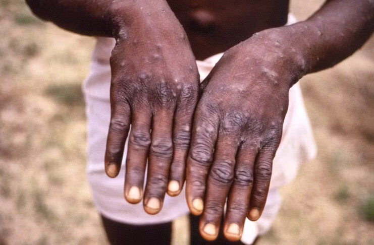 Les premiers symptômes de l'infection à Mpox (variole du singe) sont la fièvre, des douleurs musculaires, une fatigue. Puis une éruption cutanée étendue apparaît (macules, papules puis pustules). Le diagnostic de variole du singe est posé grâce à un test biologique (PCR).